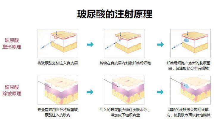 哈尔滨玻尿酸注射口碑好医院有哪些？当地6大技术专业医院推荐