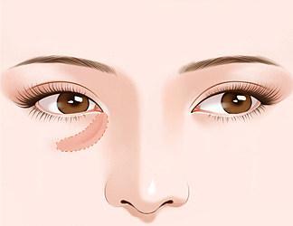 平顶山祛泪沟医院哪家技术好？精选5家专业机构助你焕亮双眸