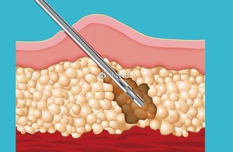 大同哪些医院做吸脂手术好？5家技术过硬口碑佳的医院推荐
