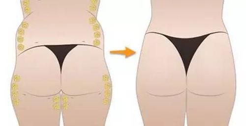 广州吸脂去副乳哪些医院靠谱？韩妃、博仕、广医三院等实力解析