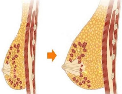 广州复合隆胸整形医院哪家强？这10家机构技术口碑双保障！